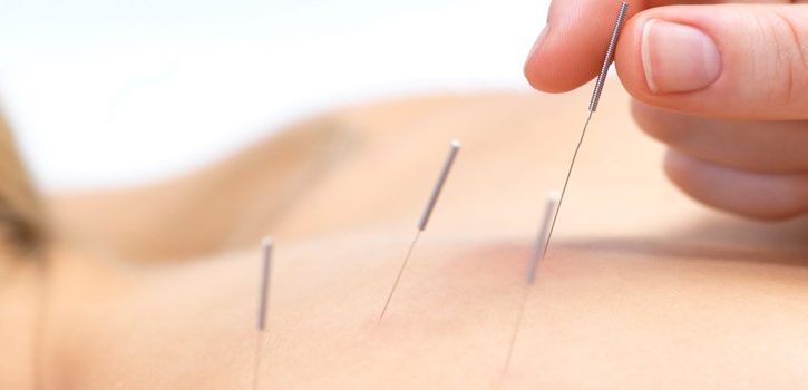 Manfaat Akupunktur untuk Kesehatan dan Kecantikan
